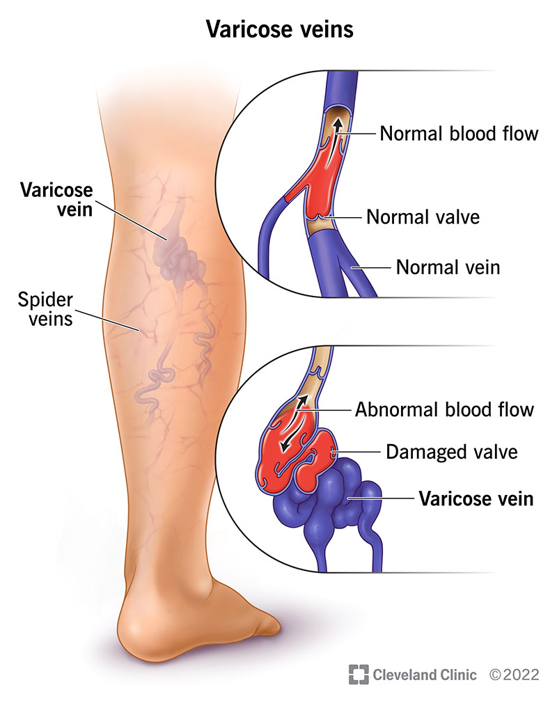 Cuando las venas se cansan de volver: la verdad detrás de las várices 2 4722 varicose veins illustration