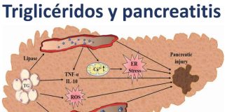 Cuando los triglicéridos se disparan: la peligrosa conexión con la pancreatitis aguda