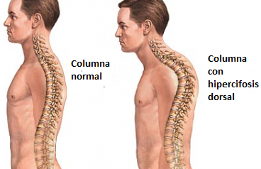 hipercifosis2 1