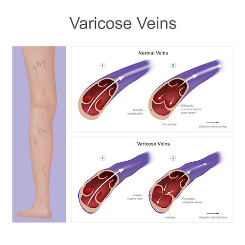 Cuando las venas se cansan de volver: la verdad detrás de las várices 1 varicose veins were healthy veins now diseased with faulty valves