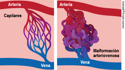 Manejo de malformaciones arteriovenosas con embolización, bajo el lente del Dr. Jaime Perna 1 AVM a esIL