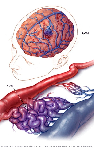 Manejo de malformaciones arteriovenosas con embolización, bajo el lente del Dr. Jaime Perna 2 mcdc7 arteriovenous malformation